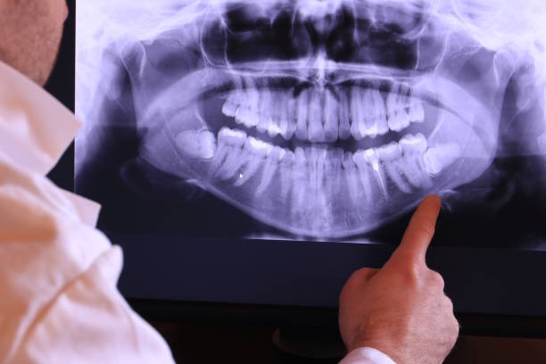 Best Knocked-Out Tooth (Avulsed Tooth) Treatment in Big Bear Lake, CA